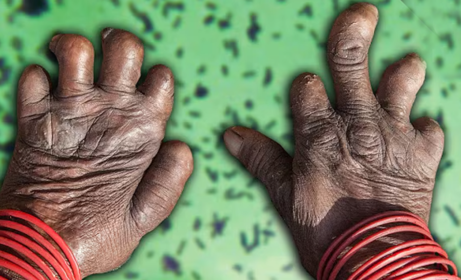 No Cases of Leprosy Recorded at Manhyia Hospital